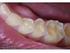 Erosão Dental: da Etiologia ao Tratamento. Dental Erosion: from Etiology to Treatment