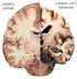 Doença de Alzheimer: características e orientações em odontologia
