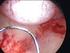 Histeroscopia ambulatorial em casos de abortamento consecutivo