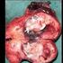 Cirurgia robótica em tumores do mediastino anterior. Descrição da técnica e relato dos primeiros casos no Brasil