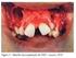 Prevalência e Prevenção da Cárie Dental: Um relato de Experiência