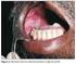 Mucosite oral e status de saúde bucal em pacientes pediátricos com câncer