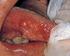 Angiogênese em carcinoma de células escamosas de língua e lábio inferior Angiogenesis in tongue and lower lip squamous cell carcinoma