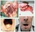 Enxerto ósseo microvascularizado na reconstrução mandibular: relato de caso