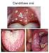 Espécies de Candida e a condição bucal de pacientes internados em Unidade de Terapia Intensiva