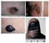 Estudo retrospectivo do melanoma maligno cutâneo: ABC,, de 1995 a 2002