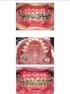 Uso de placa de levante fixa como método alternativo para a colagem dos acessórios nos dentes anteriores