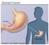 Early gastric cancer: a curable