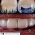 Intervenções Restauradoras Diretas em Dentes Anteriores Fraturados Associadas ao Uso de Protetor Bucal