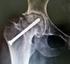 Avaliação clínica e radiográfica da osteonecrose. maxilomandibular associada ao uso de bisfosfonatos. em pacientes com câncer