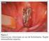Osteonecrose de mandíbula associada ao uso de bisfosfonato após instalação de implantes: relato de caso