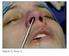Refinamento da ponta nasal: Técnica de sutura minimamente invasiva para a ponta nasal larga