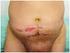 Tratamento das hérnias incisionais nas abdominoplastias multifuncionais