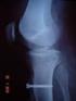Luxação traumática de joelho: análise clínica