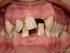 Trauma dentário como fator de inversão na erupção dentária e dilaceração radicular relato de caso