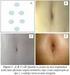 Abdominoplastias: neo-onfaloplastia sem cicatriz e sem excisão de gordura