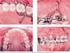 Protocolo para ancoragem absoluta em ortodontia: miniparafuso