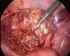 Surgical treatment of deep endometriosis: a 16 case series Tratamento cirúrgico da endometriose profunda: série de 16 casos