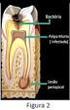 TRATAMENTO DE DENTES COM LESÃO PERIAPICAL CRONICA. INFLUÊNCIA DE DIFERENTES TIPOS DE CURATIVO DE DEMORA E DO MATERIAL OBTURADOR DE CANAL RADICULAR