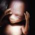 Anomalias e prognóstico fetal associados à translucência nucal aumentada e cariótipo anormal