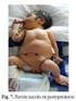 Síndrome de Prune Belly: relato de caso