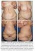 Abdominoplastia vertical para tratamento do excesso de pele abdominal após perdas ponderais maciças