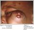 Rabdomiossarcoma de cabeça e pescoço: 24 casos e revisão da literatura