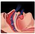 Complicações e conseqüências da apnéia obstrutiva do sono.