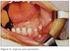 Cisto dermoide em assoalho bucal: 2 casos clínicos