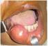 Lipomas da Região Oral e Maxilofacial: Estudo Retrospectivo de 16 Anos no Brasil