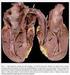 Efeitos do Marcapasso na Cardiomiopatia Hipertrófica