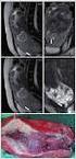 Valor da ressonância magnética no diagnóstico antenatal do acretismo placentário
