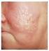 Infecção estreptocócica da pele, caracterizada pelo aparecimento de manchas vermelhas com borda nitidamente demarcada.