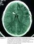Imagem no traumatismo craniano. Imaging of traumatic brain injury