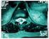 Anestesia Espinhal com 10 mg de Bupivacaína Hiperbárica Associada a 5 µg de Sufentanil para Cesariana. Estudo de Diferentes Volumes *