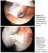 Avaliação funcional do reparo artroscópico da lesão do manguito rotador em pacientes com pseudoparalisia