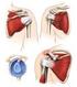 Roturas Completas do Manguito Rotador: Tratamento Cirúrgico