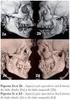 USO DA TOMOGRAFIA COMPUTADORIZADA NAS FRATURAS FACIAIS USE OF TOMOGRAPHY COMPUTADORIZED IN THE FACIAL FRACTURES