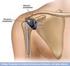 Artroplastia de Ombro TRATAMENTO POR ARTROPLASTIA NAS FRATURAS DO ÚMERO PROXIMAL INDICAÇÃO. partes? rachadura da