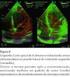 Estudo Ecocardiográfico do Ventrículo Direito em Pacientes com Hipertensão Pulmonar por Esquistossomose Mansoni