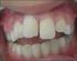 Knowledge of dental students of avulsed permanent teeth