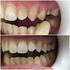 Retenção de Cimentos Provisórios em Dentes Naturais para Próteses Fixas Unitárias