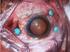 Vitrectomia transconjuntival 25 gauge via pars plana para opacidade vítrea persistente em pacientes com implante de lentes multifocais