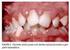Condição periodontal de crianças e adolescentes com diabetes melito tipo 1