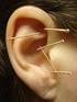 The treatment of tinnitus is still a challenge. Acupuncture is