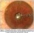 A previsibilidade biométrica nas lentes intra-oculares multifocais
