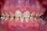 Defeitos de desenvolvimento de esmalte em primeiros molares permanentes: relato de caso e análise morfológica