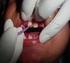 TRATAMENTO RESTAURADOR ATRAUMÁTICO: uma alternativa para o controle da cárie dentária no serviço público de saúde de Bias Fortes - MG