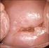 Lesão cervical intraepitelial