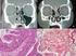Hamartoma adenomatóide epitelial respiratório: Caso clínico e revisão da literatura